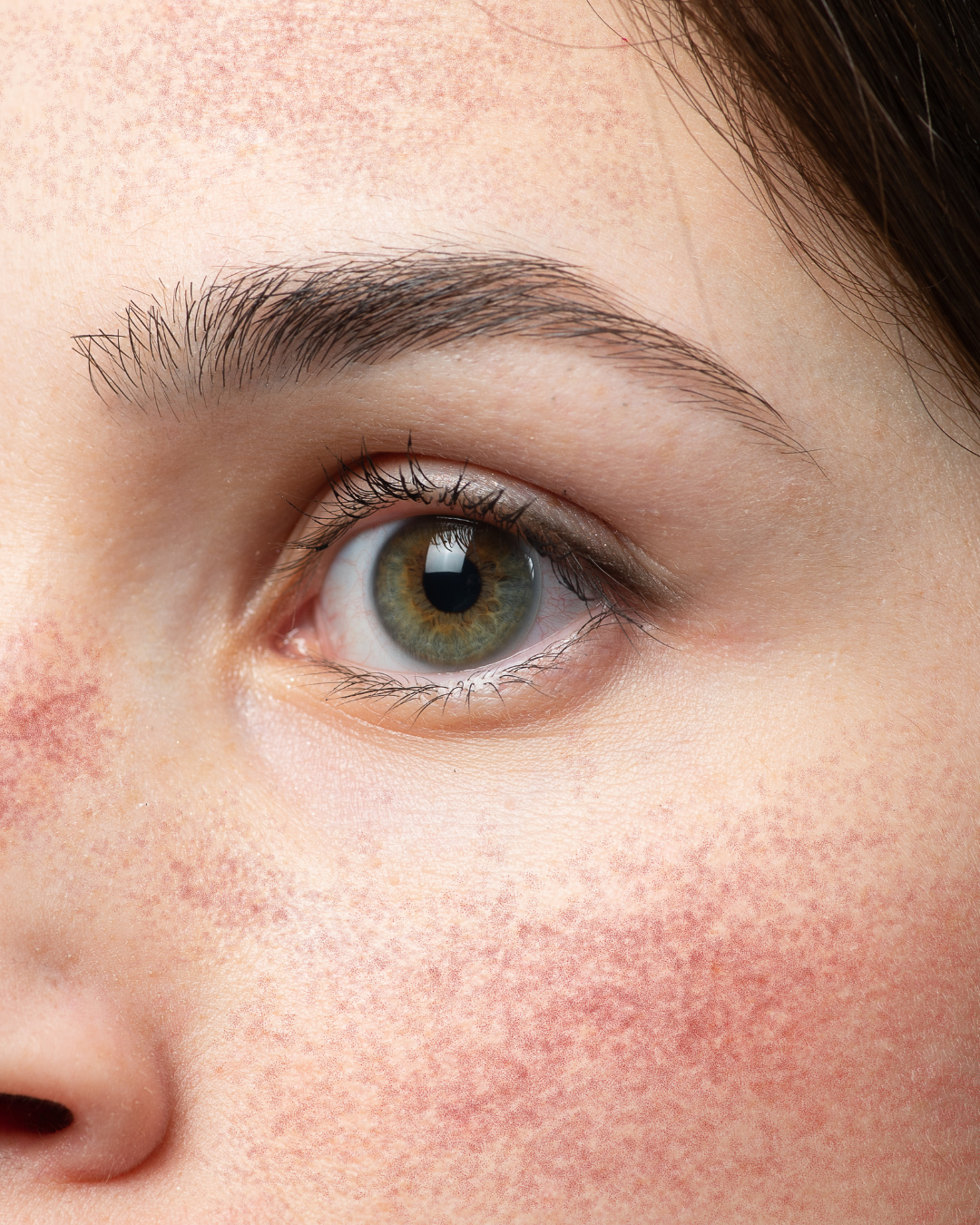 Rosacea