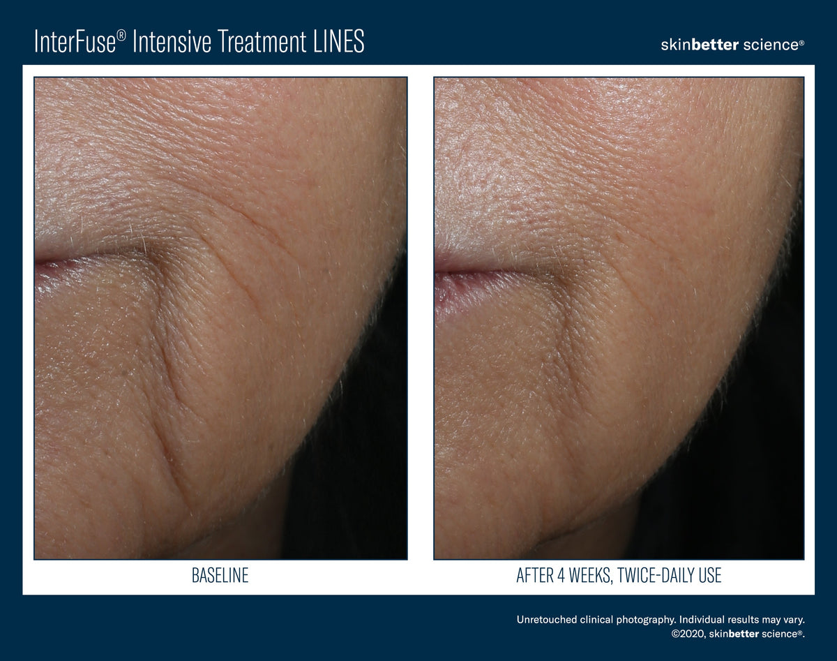 InterFuse Intensive Treatment LINES 15 ml
