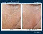 InterFuse Intensive Treatment LINES 15 ml