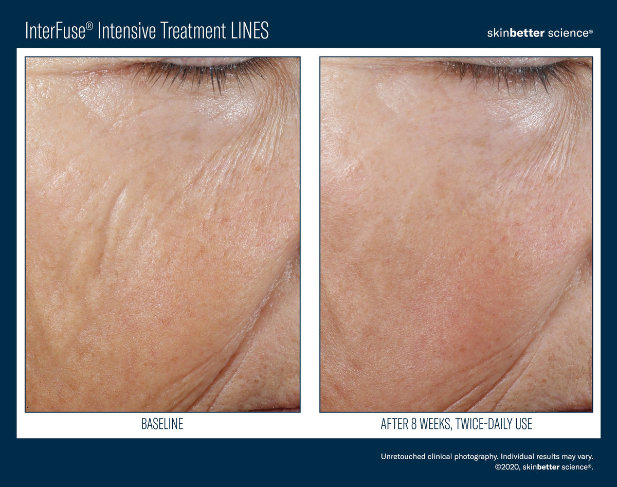InterFuse Intensive Treatment LINES 15 ml