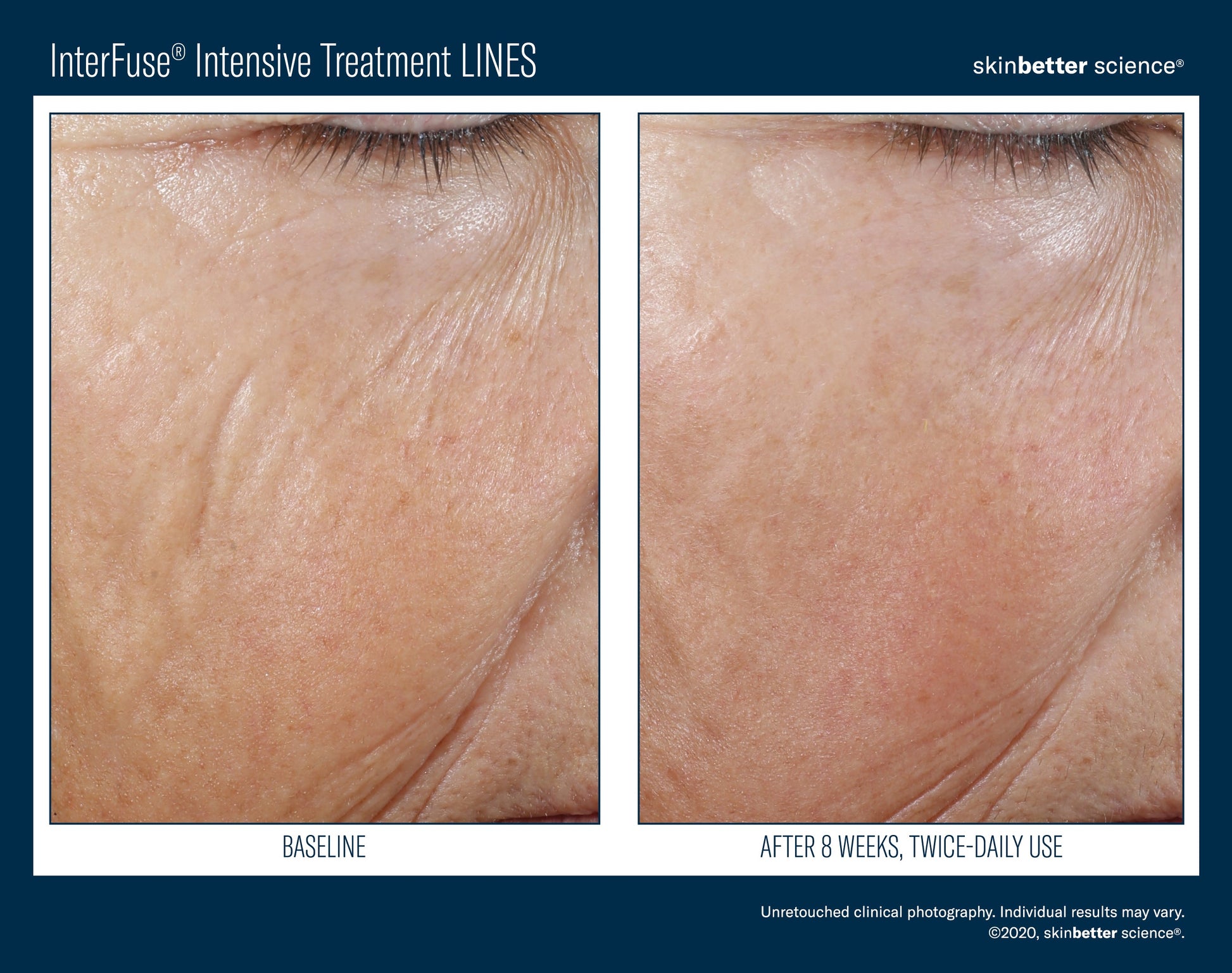 InterFuse Intensive Treatment LINES 30 ml
