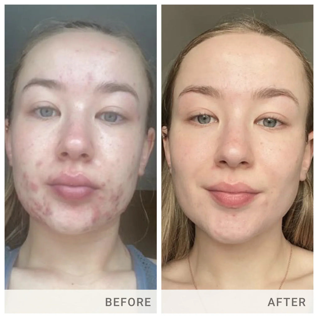 Skin Accumax