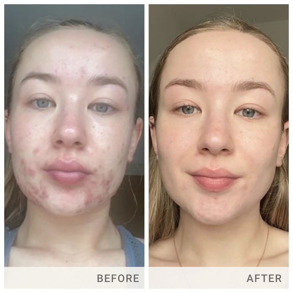 Skin Accumax